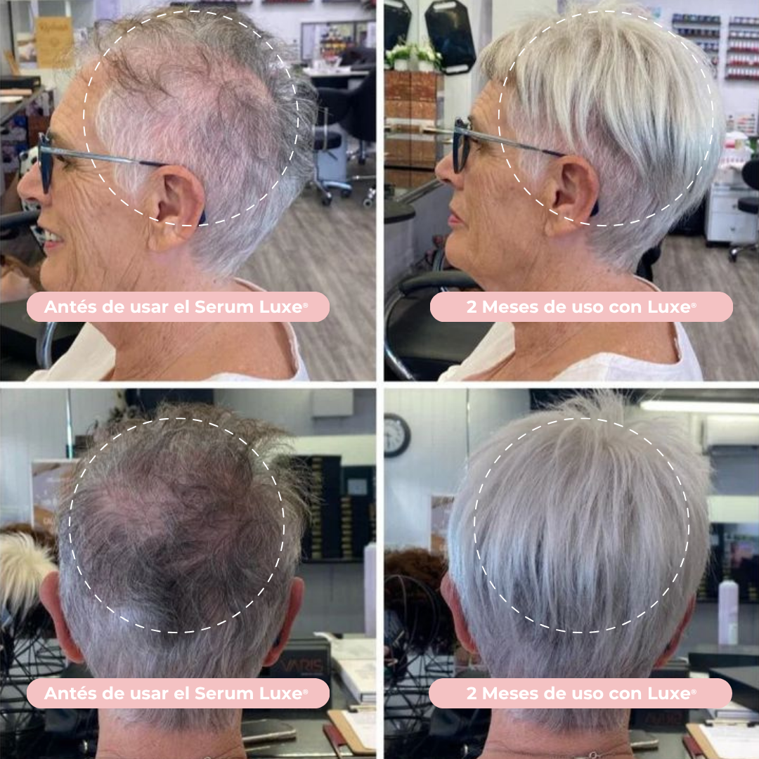 Serum de Crecimiento Capilar Luxe® Resultados en 14 días