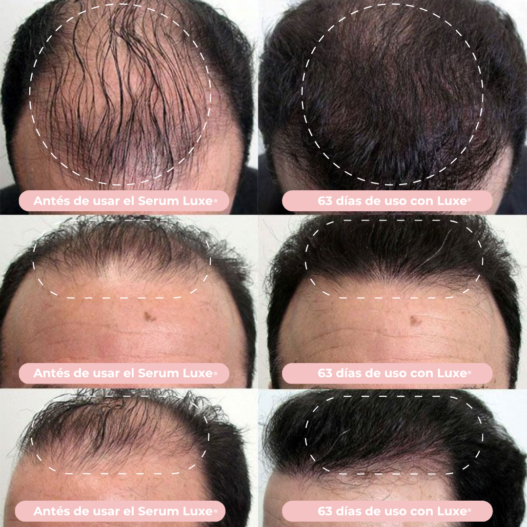 Serum de Crecimiento Capilar Luxe® Resultados en 14 días