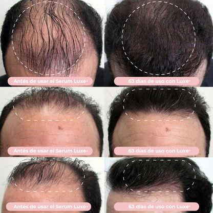 Serum de Crecimiento Capilar Luxe® Resultados en 14 días